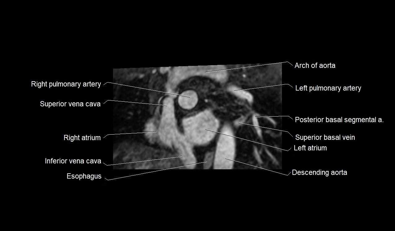 MRI heart and coronary arteries short axis anatomy image 8.webp